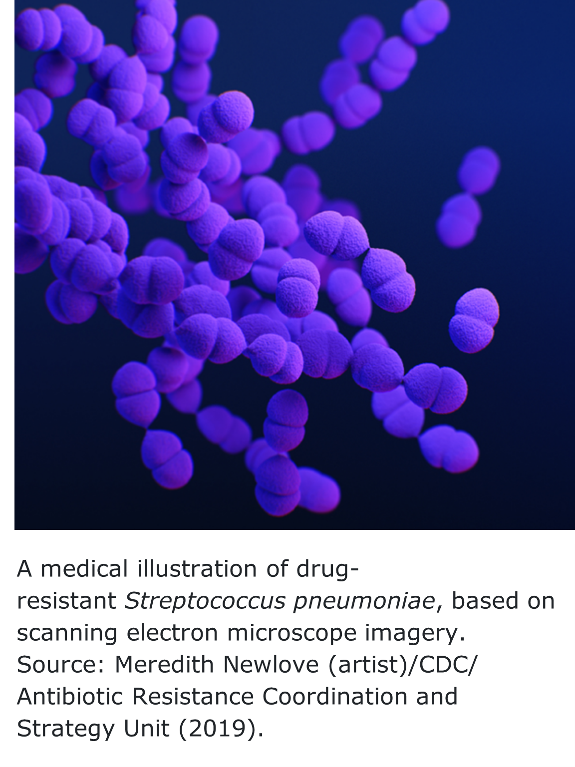 "Clumps of purple colored di-cocci bacteria "