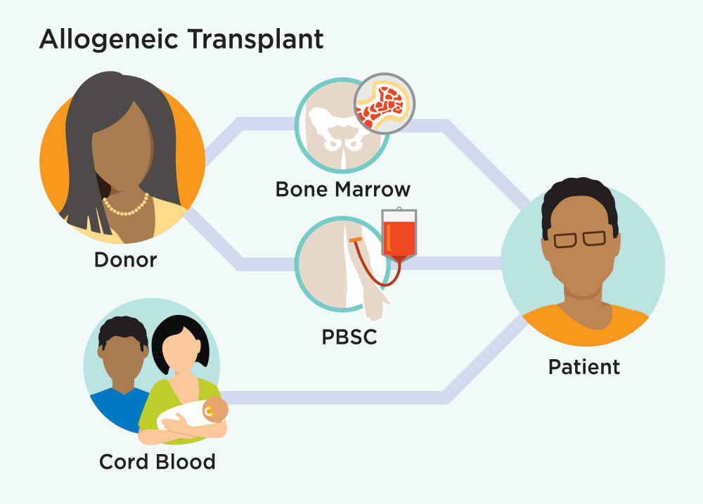 Allogeneic Transplant