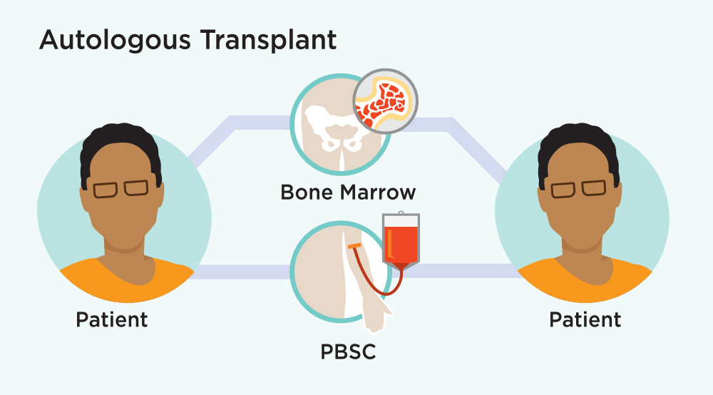 Autologous Transplant