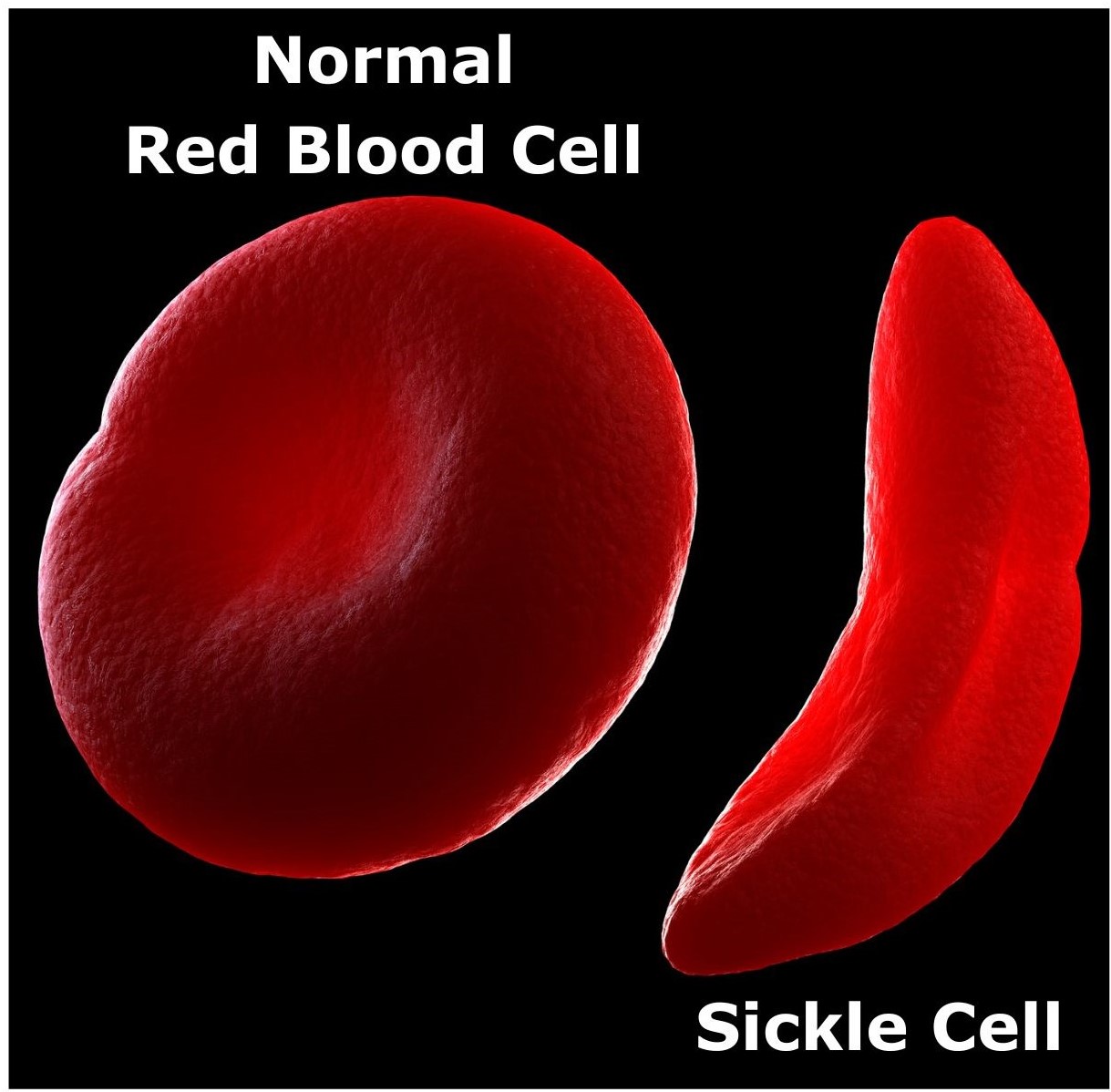 A normal red blood cell (bi-concave disc) compared to a sickled red blood cell (Crescent shaped).