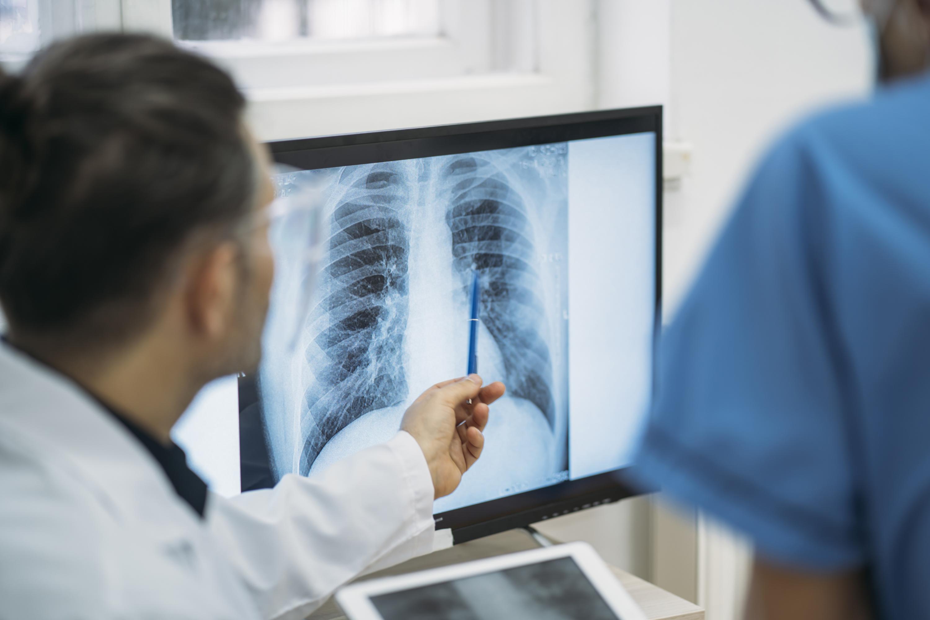 Doctor reviewing x-ray of a patient’s lungs.