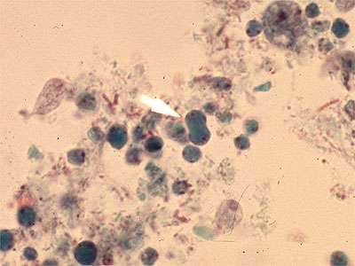 Blastocystis hominis