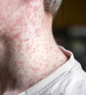 A boy with active measles rash