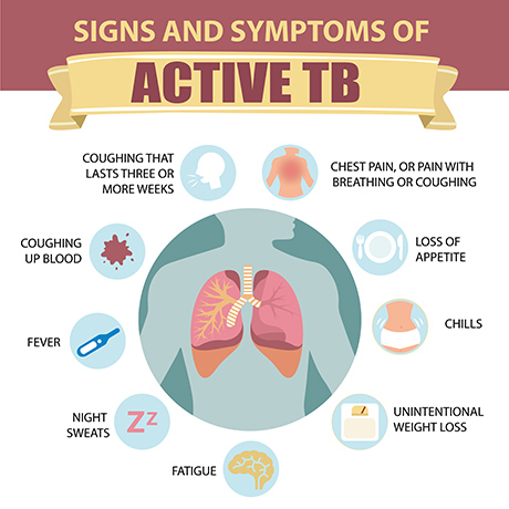 Signs and Symptoms of Active TB