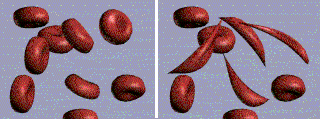 Normal red blood cells and sickle-shaped cells.