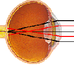 astimatism eyeball