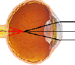 nearsigited eyeball