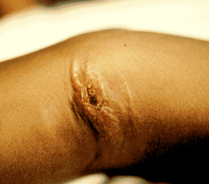 Cutaneous Lesion Image
