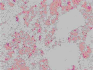 Tularemia